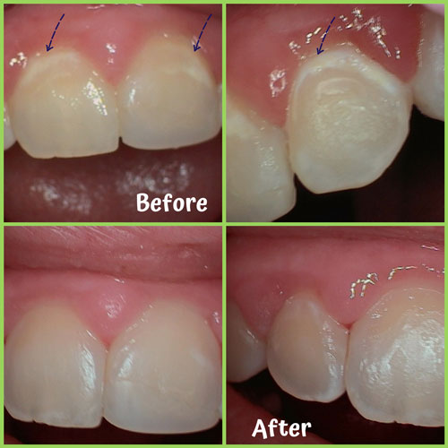 Icon® Dental Treatment, White Spots and Discolored Tooth Treatment